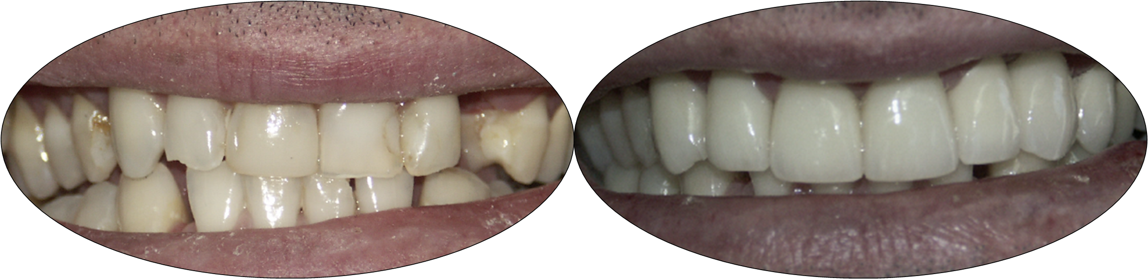 Before and after smile photos of patient with porcelain crowns