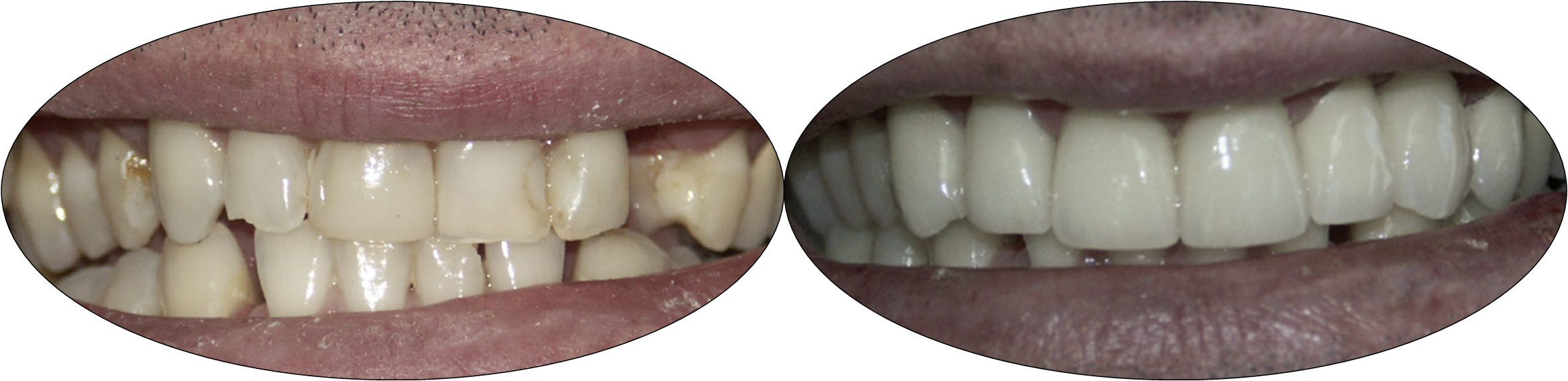 Before and after smile photos of patient with porcelain crowns