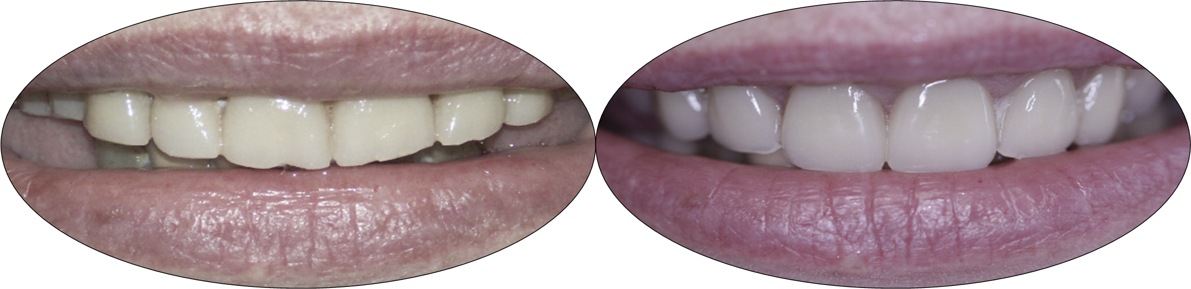 Smile photos, before and after porcelain crowns