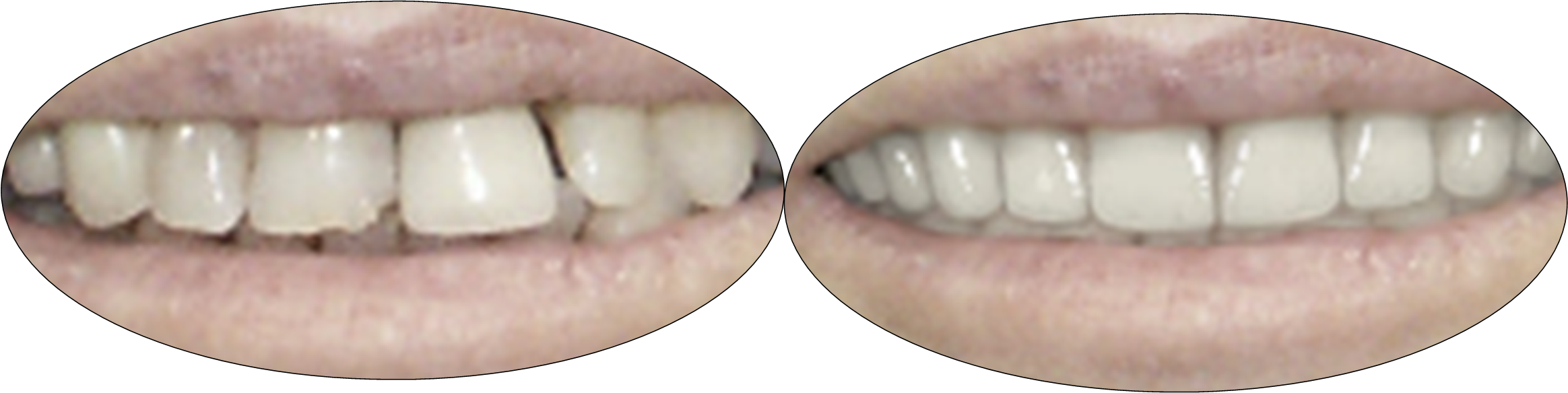 Patient before and after crowns and porcelain veneers