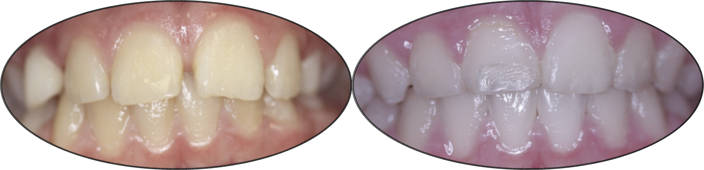 Smile gallery images, before and after orthodontics, patient three