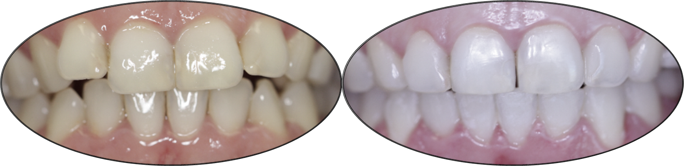 Smile gallery images, before and after orthodontics, patient one