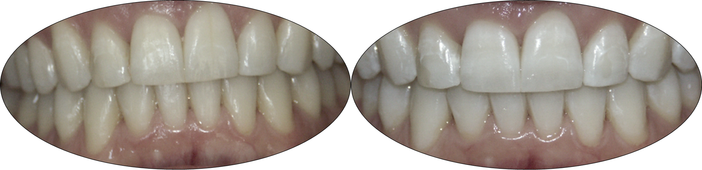 Before and after images of Zoom teeth whitening patient
