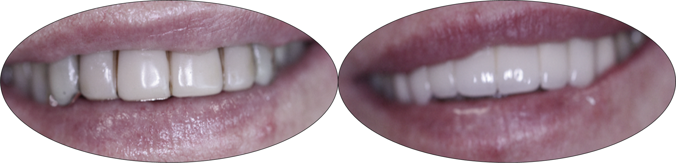 Before and after pictures of patient with porcelain fixed bridge