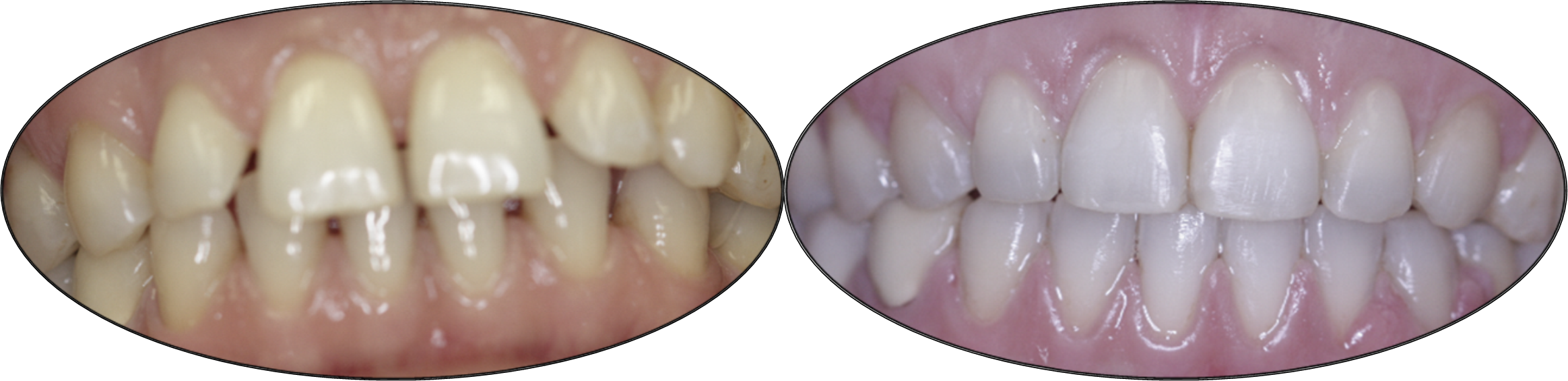 Smile gallery images, before and after orthodontics, patient four