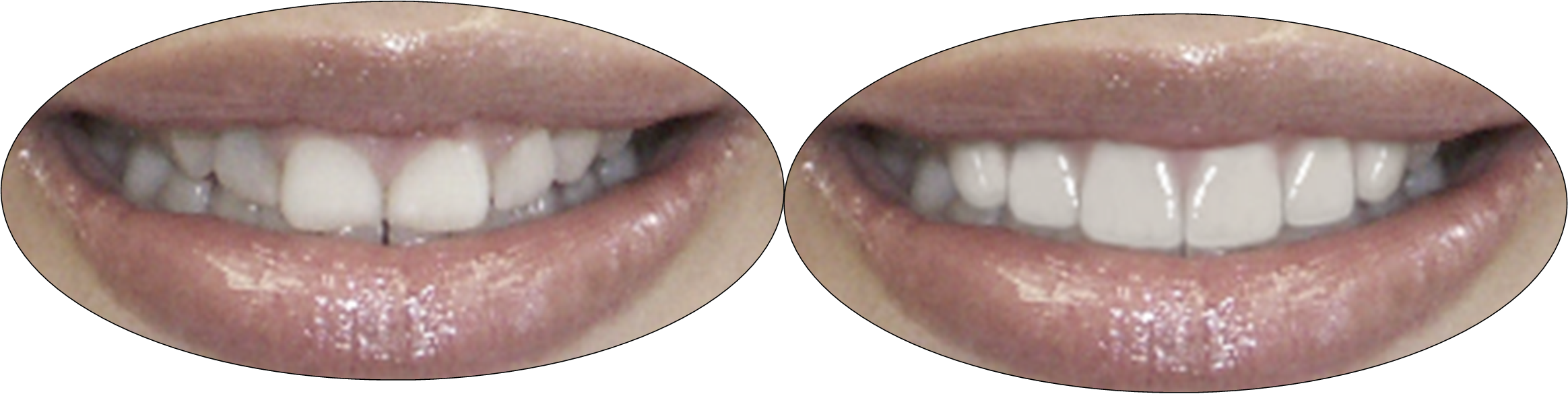 Smile gallery images, before and after crown lengthening and porcelain veneers