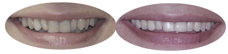 Before and after images of orthodontics patient