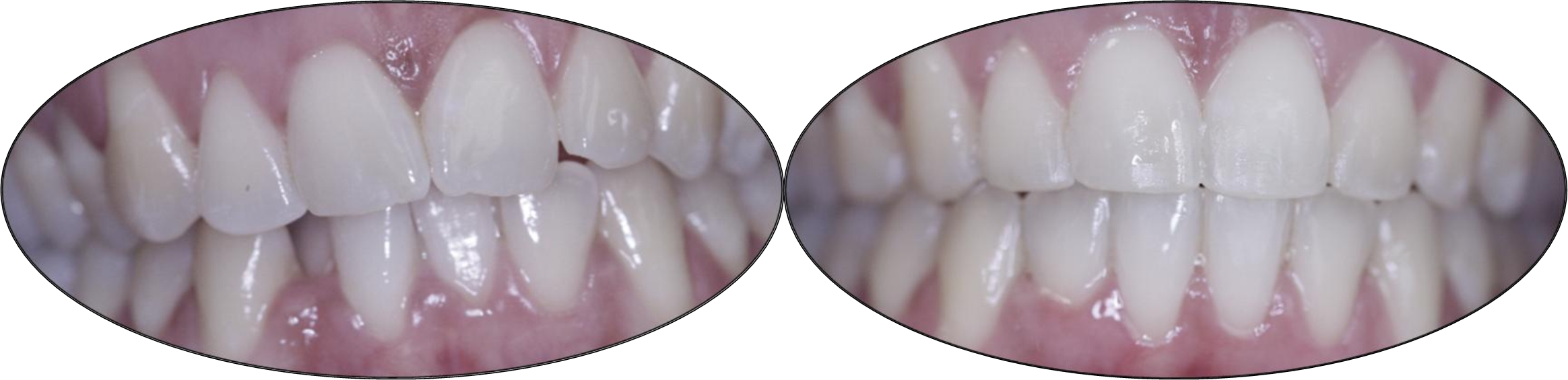 Smile gallery images, before and after orthodontics, patient two