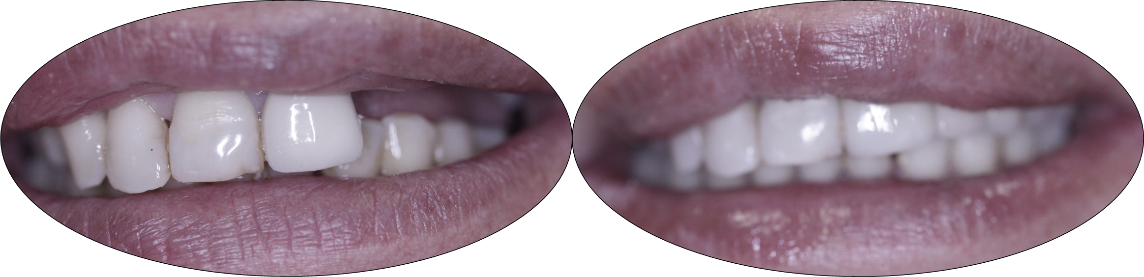 Before and after images of implant bridge placement