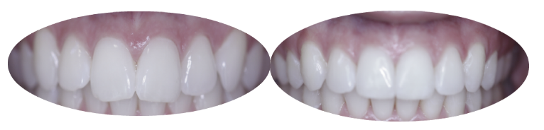 Before and after images of Invisalign patient
