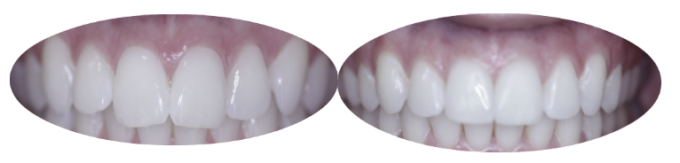 Before and after images of Invisalign patient