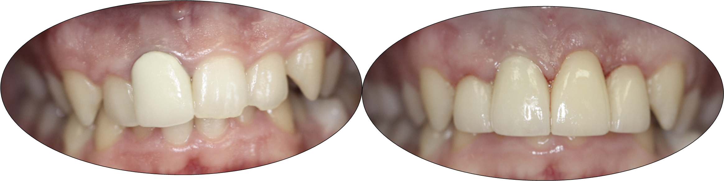Before and after images of Crown Lengthening, Crowns and Laminates