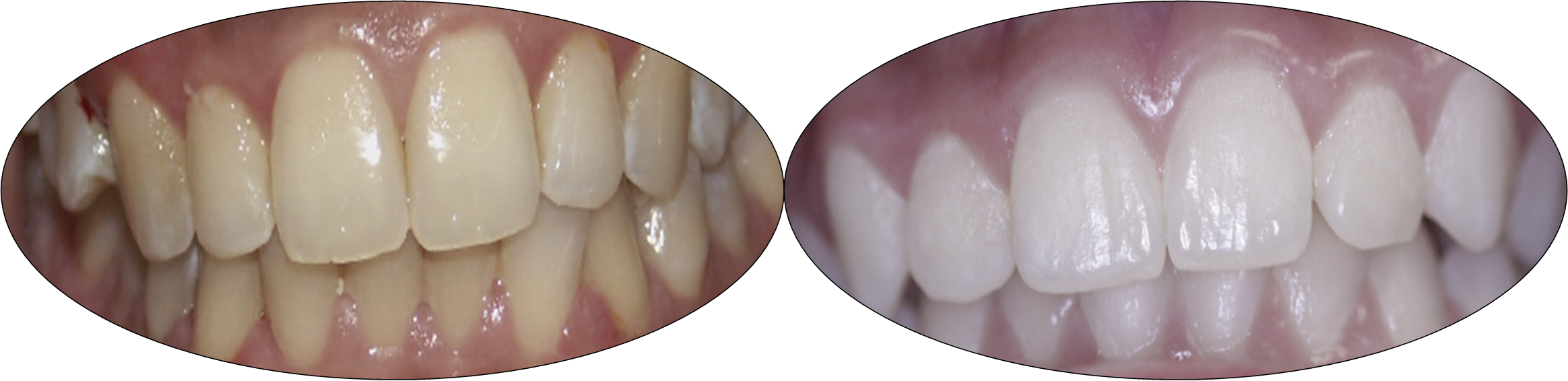Smile gallery images, before and after Invisalign, patient three