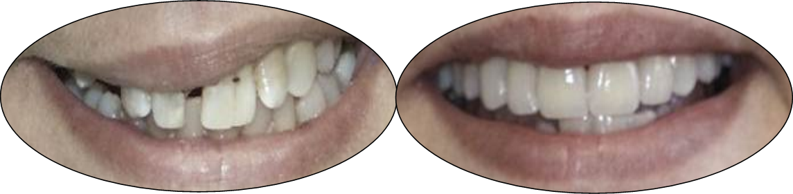 Before and after images of dental crowns patient