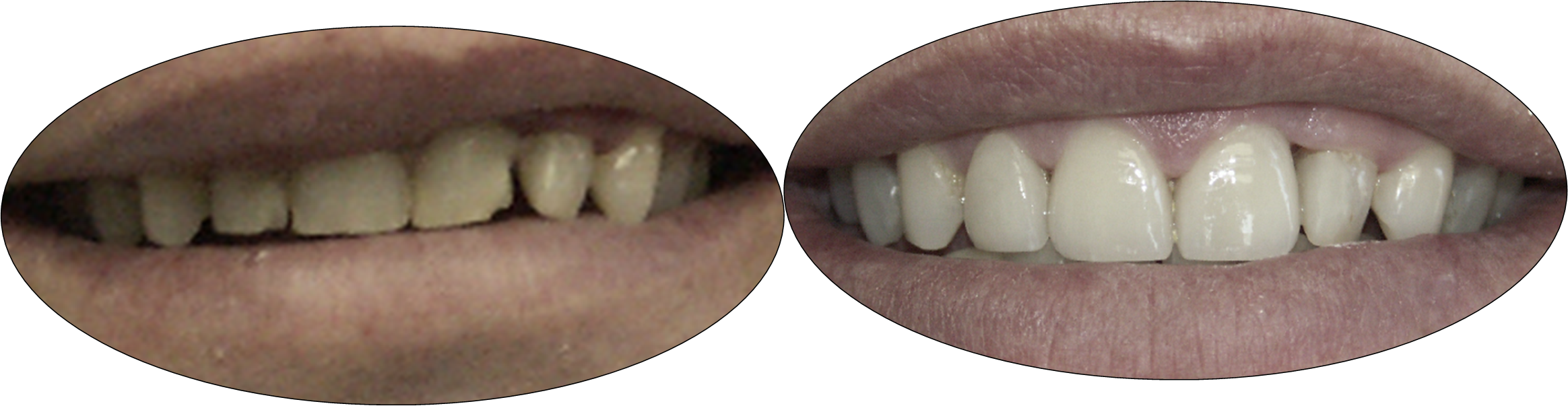 Patient smile gallery photos, before and after porcelain crowns