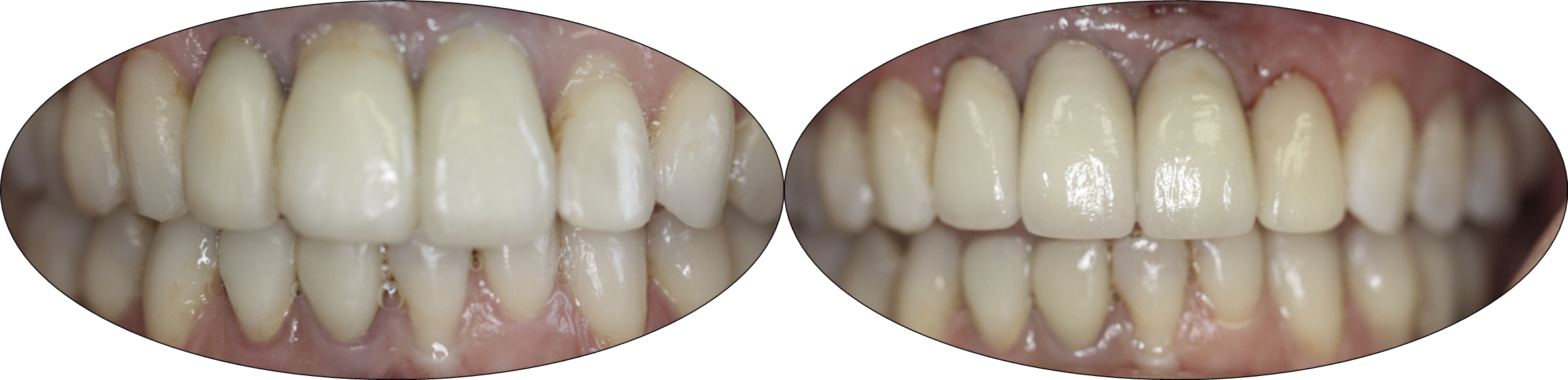 Before and after images of porcelain crowns over dental implants