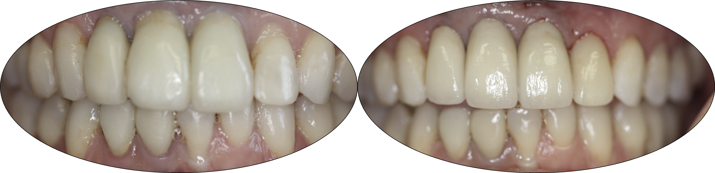 Before and after images of porcelain crowns over dental implants