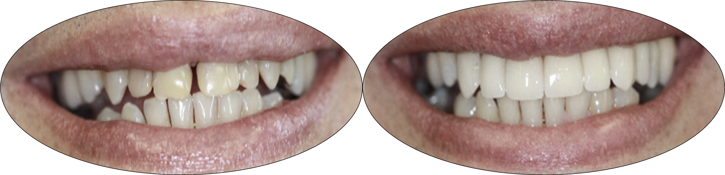 Before and after images of Porcelain Crowns and Porcelain Veneers