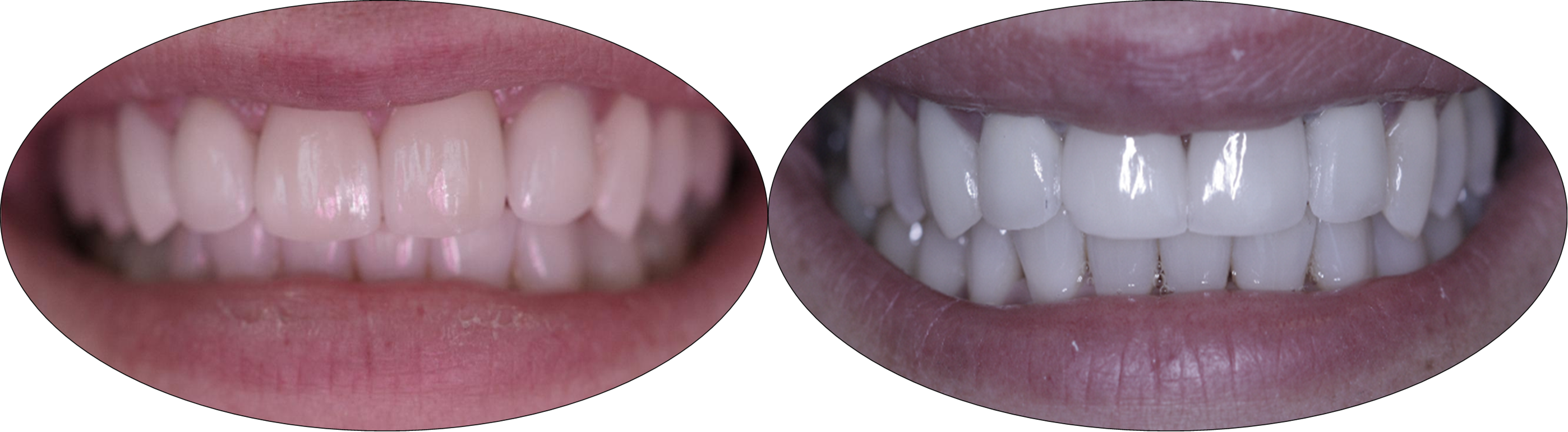 Before and after pictures of patient with porcelain veneers and crowns