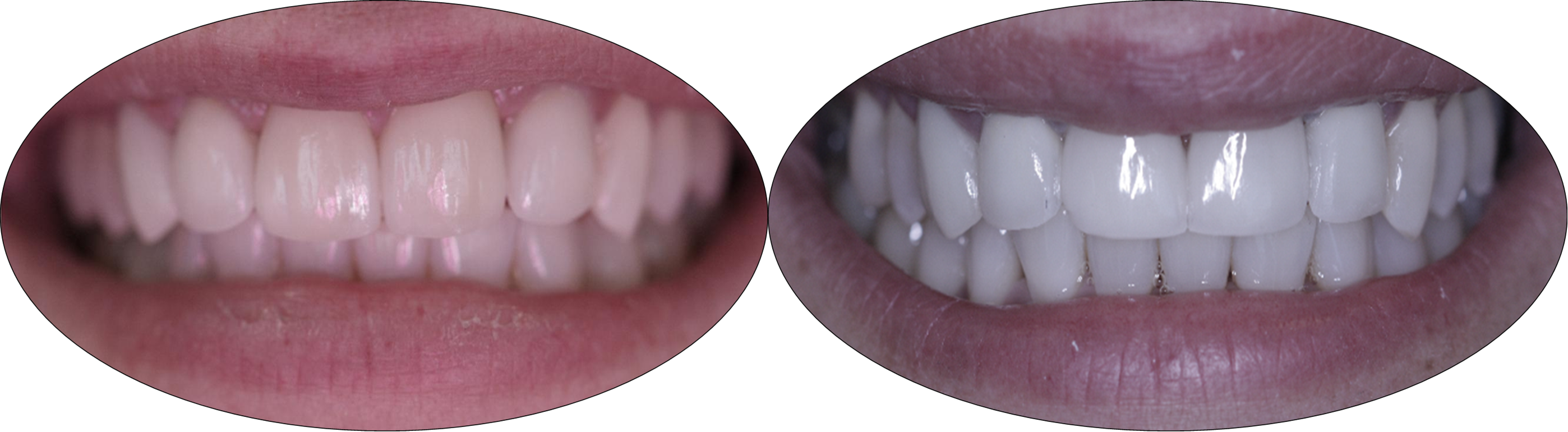 Before and after pictures of patient with porcelain veneers and crowns