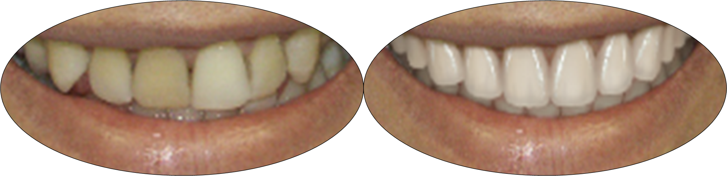 Before and after smile photos of patient with porcelain veneers