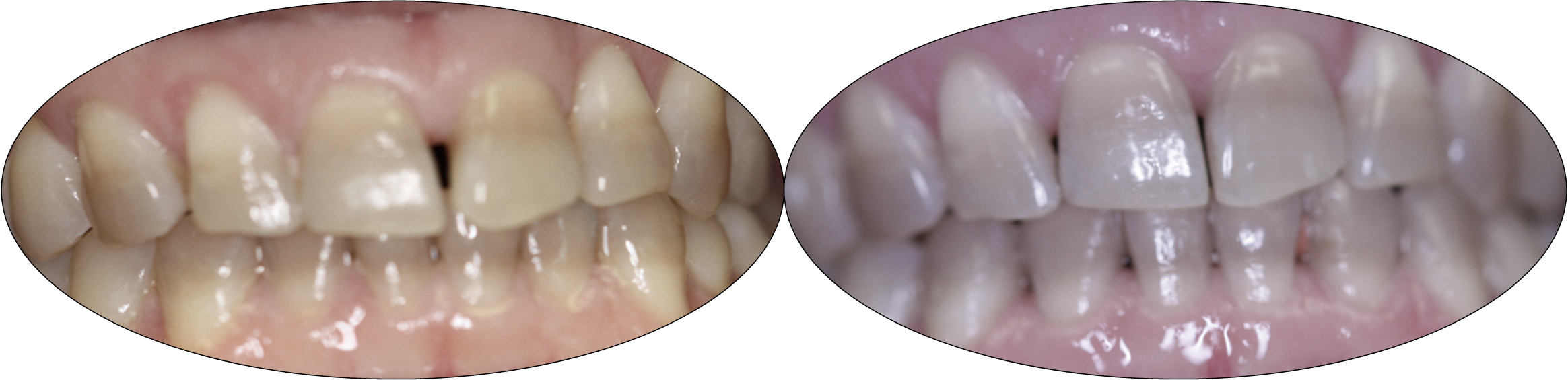Smile gallery images, before and after Invisalign, patient two