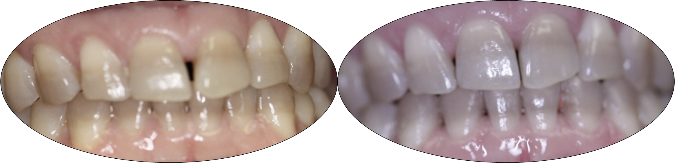 Smile gallery images, before and after Invisalign, patient two