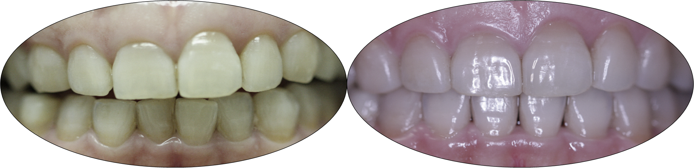 Smile gallery images, before and after Invisalign, patient one